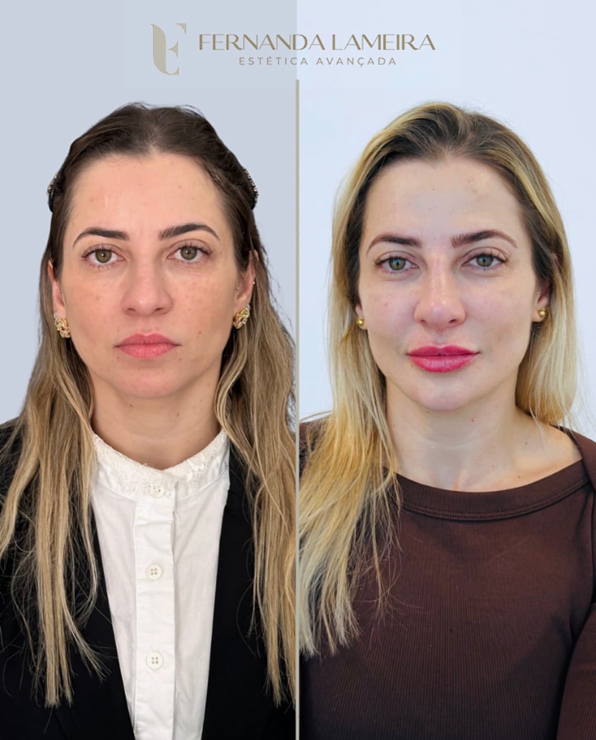 Resultado harmonização facial BH 1