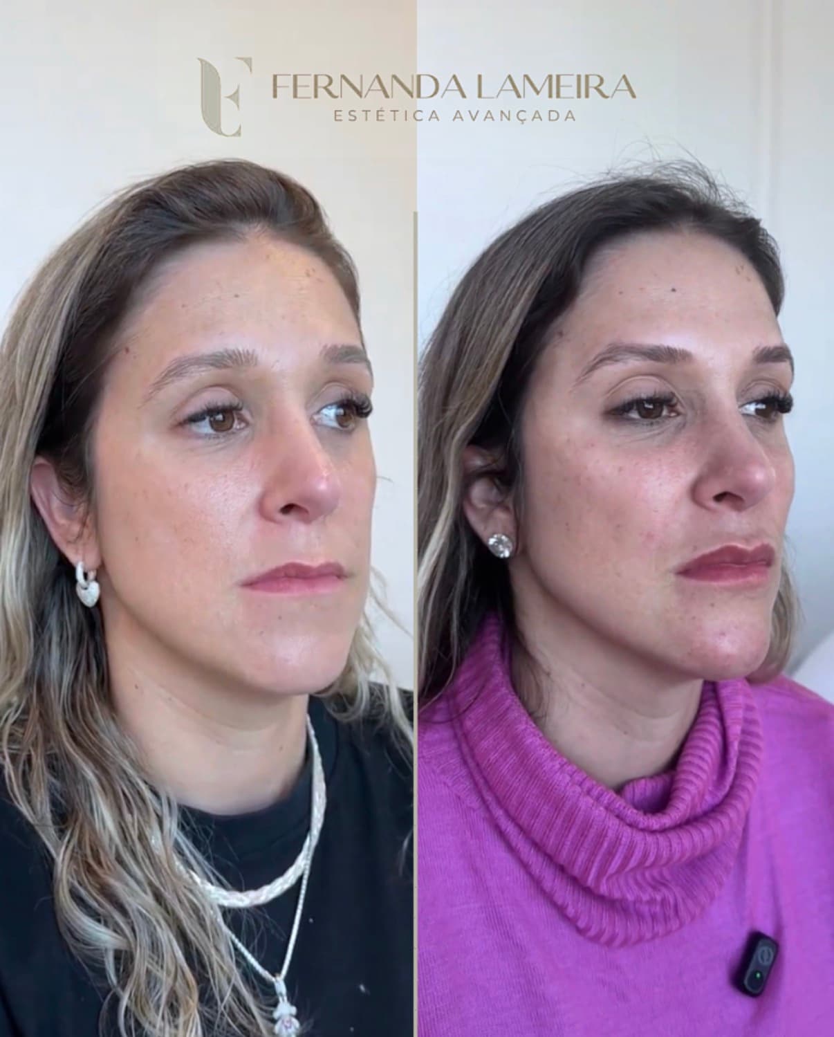 Resultado harmonização facial BH 10
