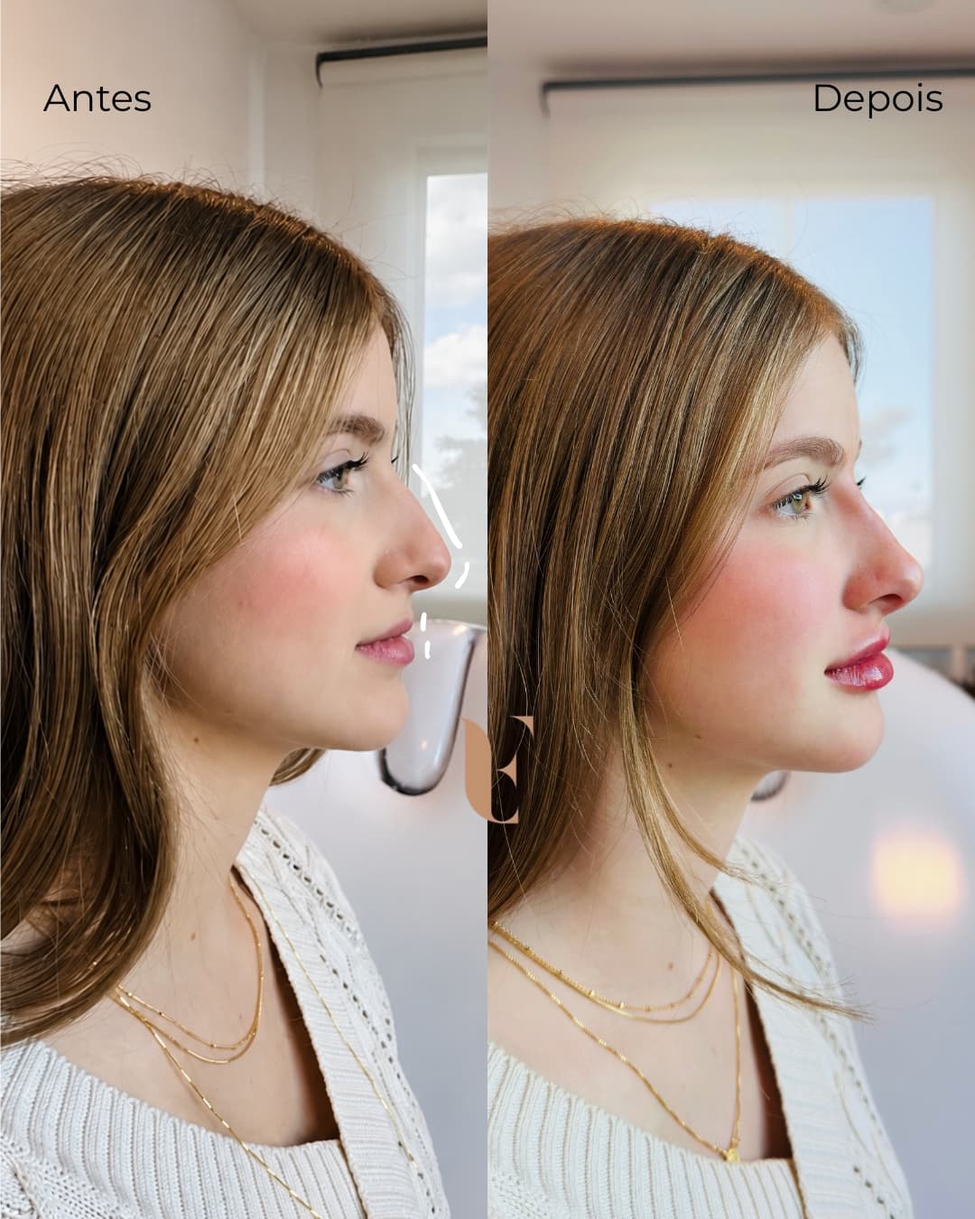 Resultado harmonização facial BH 12