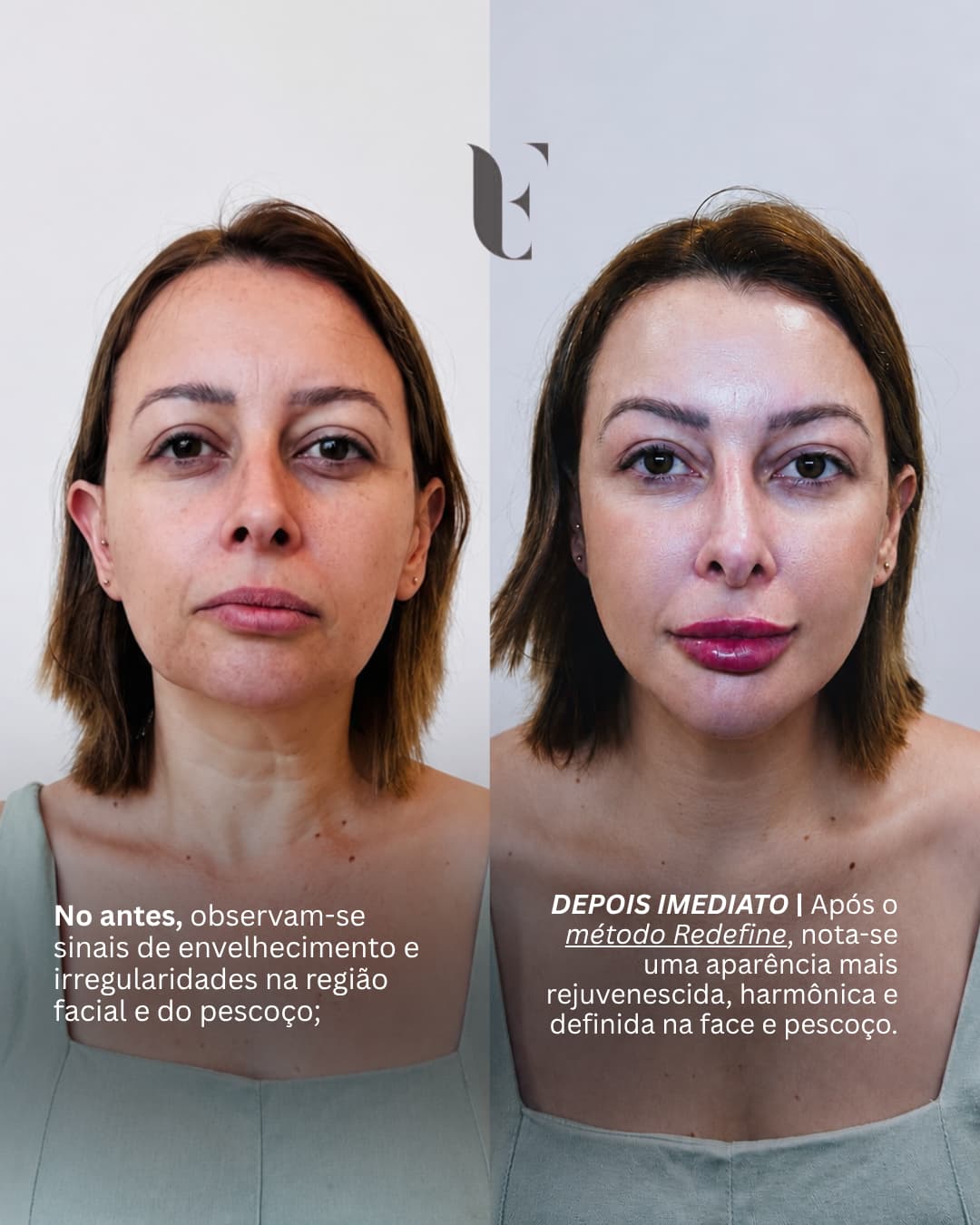 Resultado harmonização facial BH 3