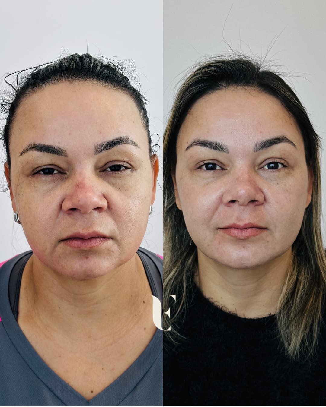 Resultado harmonização facial BH 5