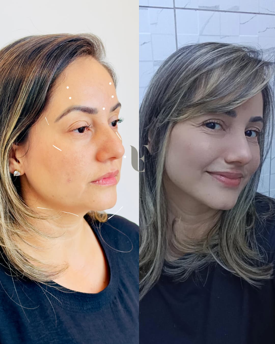 Resultado harmonização facial BH 6