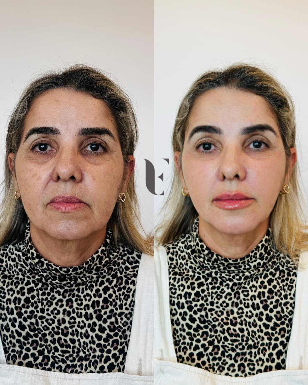 Resultado harmonização facial BH 7