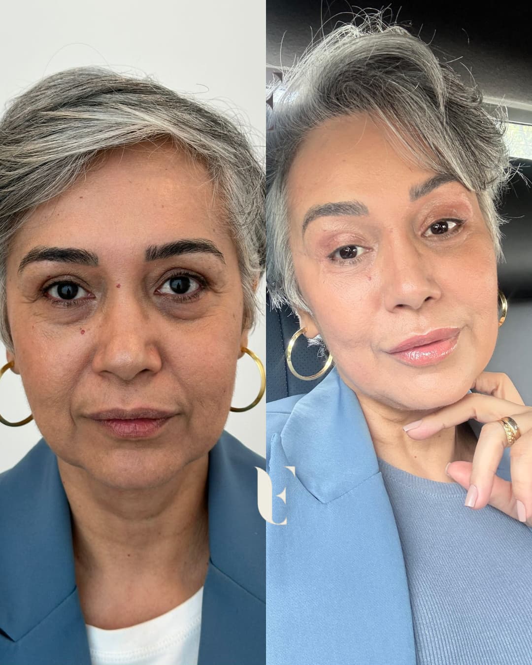 Resultado harmonização facial BH 8