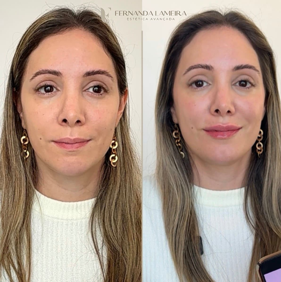 Resultado harmonização facial BH 9